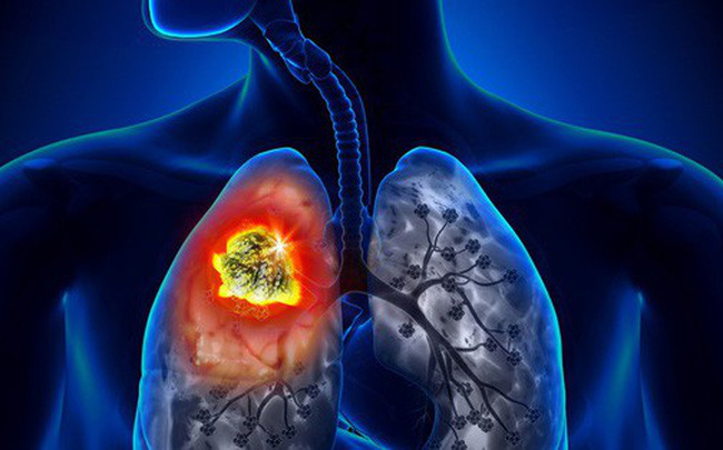 Ngoài các dấu hiệu trên, ung thư phổi cũng có các triệu chứng chung như mệt mỏi hoặc giảm cân không rõ nguyên nhân